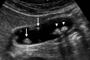 Gallbladder Polyps Treatment In Pune Kaizen Gastro Care