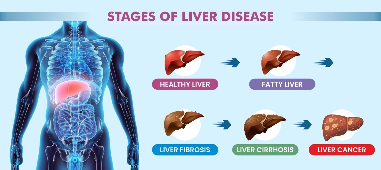 Liver Cirrhosis 2nd Stage