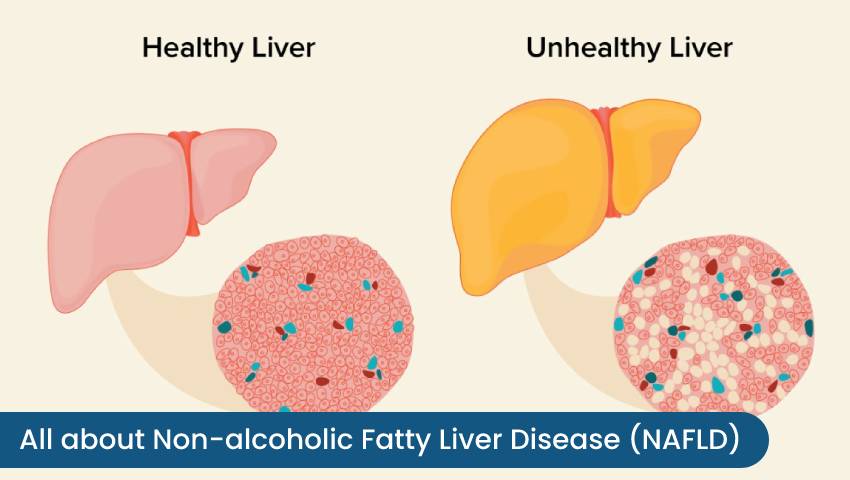 All About Non alcoholic Fatty Liver Disease NAFLD Kaizen Gastro Care