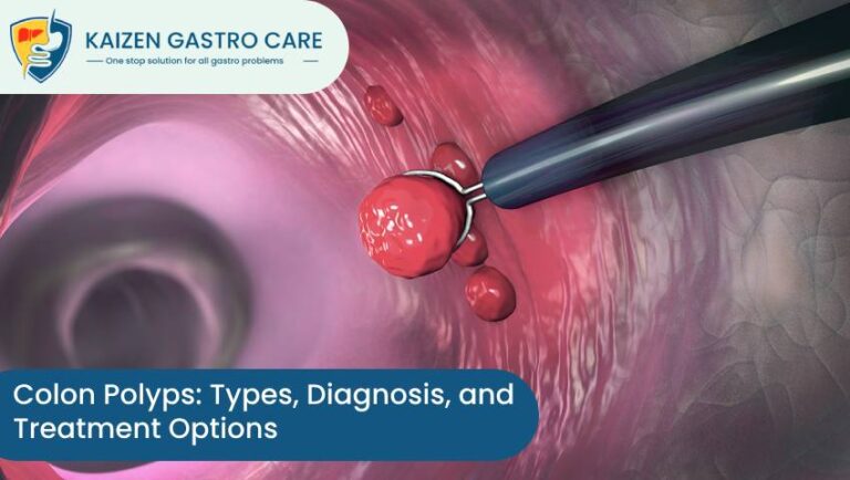 Colon Polyps Types Diagnosis And Treatment Options Kaizen Gastro Care 2642