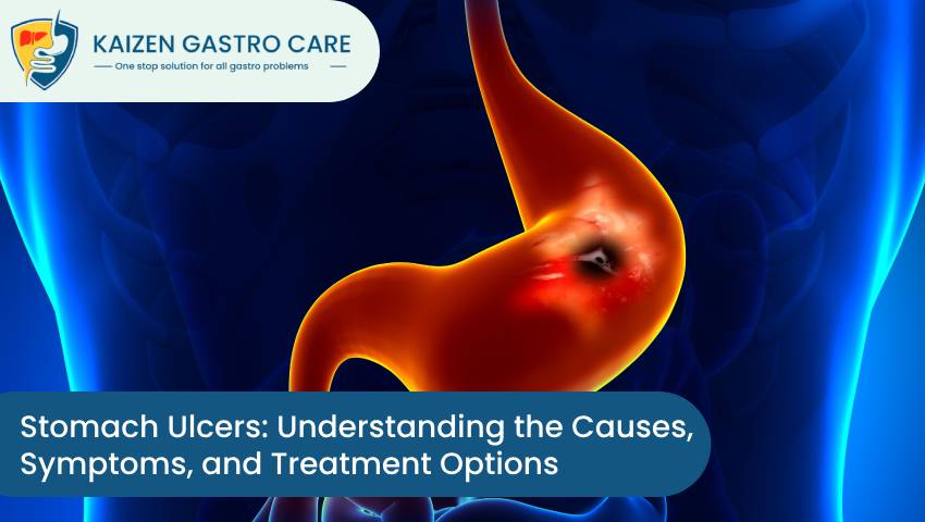 Stomach Ulcers: Understanding the Causes, Symptoms, and Treatment Options