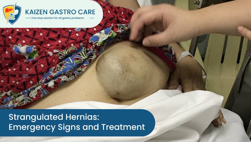 Strangulated Hernias: Emergency Signs and Treatment