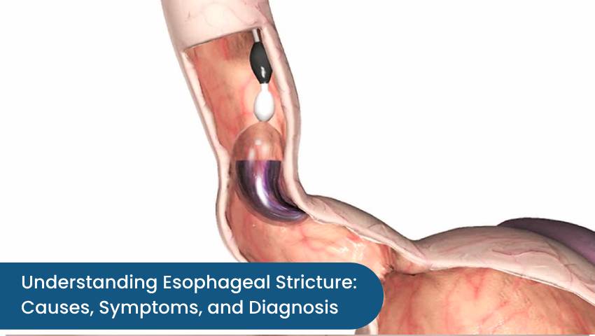 Understanding Esophageal Stricture: Causes, Symptoms, and Diagnosis