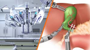 Robotic Cholecystectomy