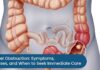 Bowel Obstruction: Symptoms, Causes, and When to Seek Immediate Care