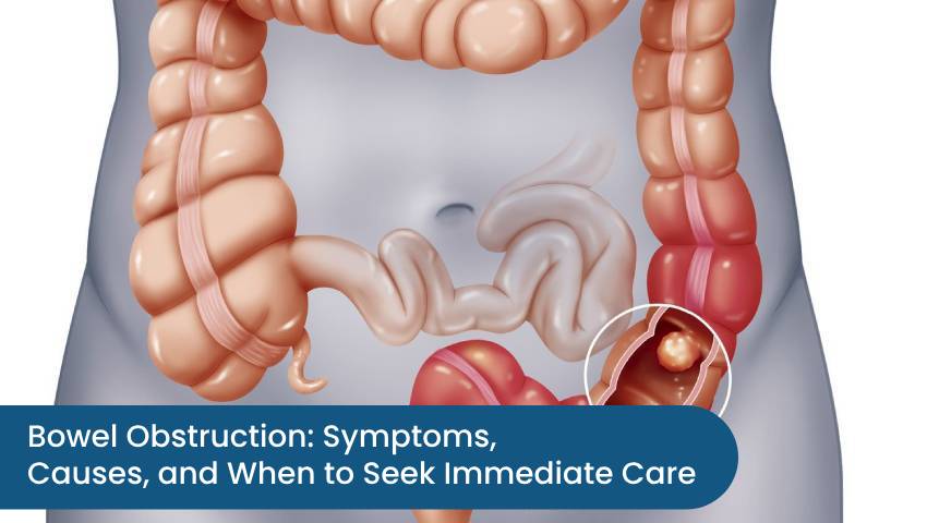 Bowel Obstruction: Symptoms, Causes, and When to Seek Immediate Care