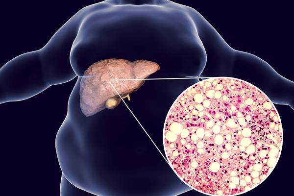 Non-Alcoholic Fatty Liver Disease (NAFLD) Treatment in Pune- Kaizen Gastro Care